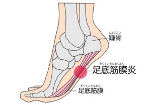 足底筋膜炎