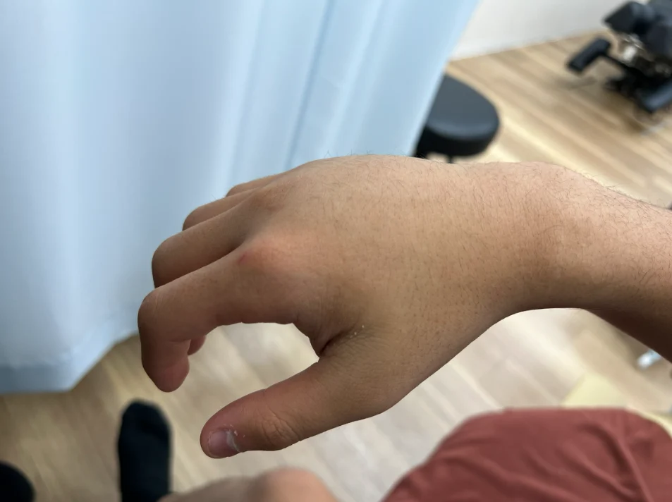 受傷後の右手の甲の状態