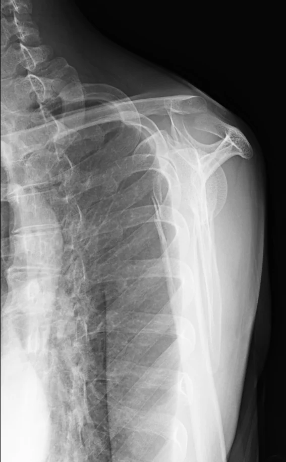 左上腕骨外科頸骨折の初期レントゲン画像2