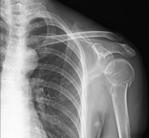 【症例】40代女性 骨折後に左腕が上がりにくい｜上腕骨外科頸骨折後のリハビリ