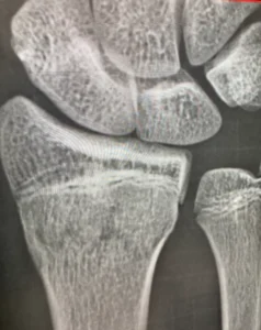 【症例】10代男性 サッカー部のコーレス骨折｜ギプス固定中のトレーニングから競技復帰まで