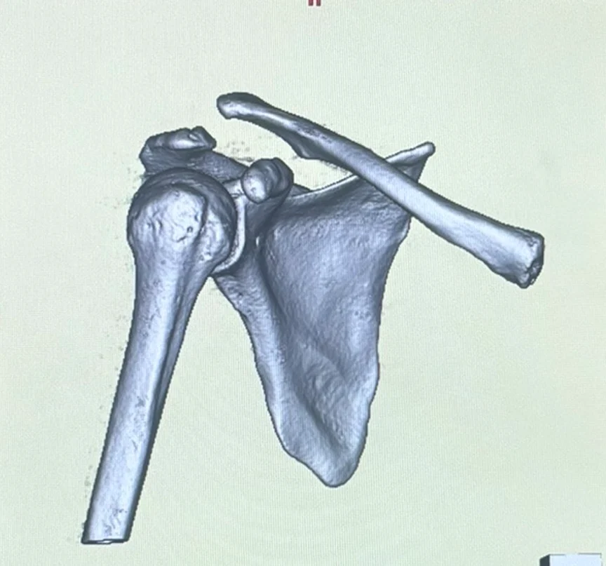 肩鎖関節脱臼のCT画像