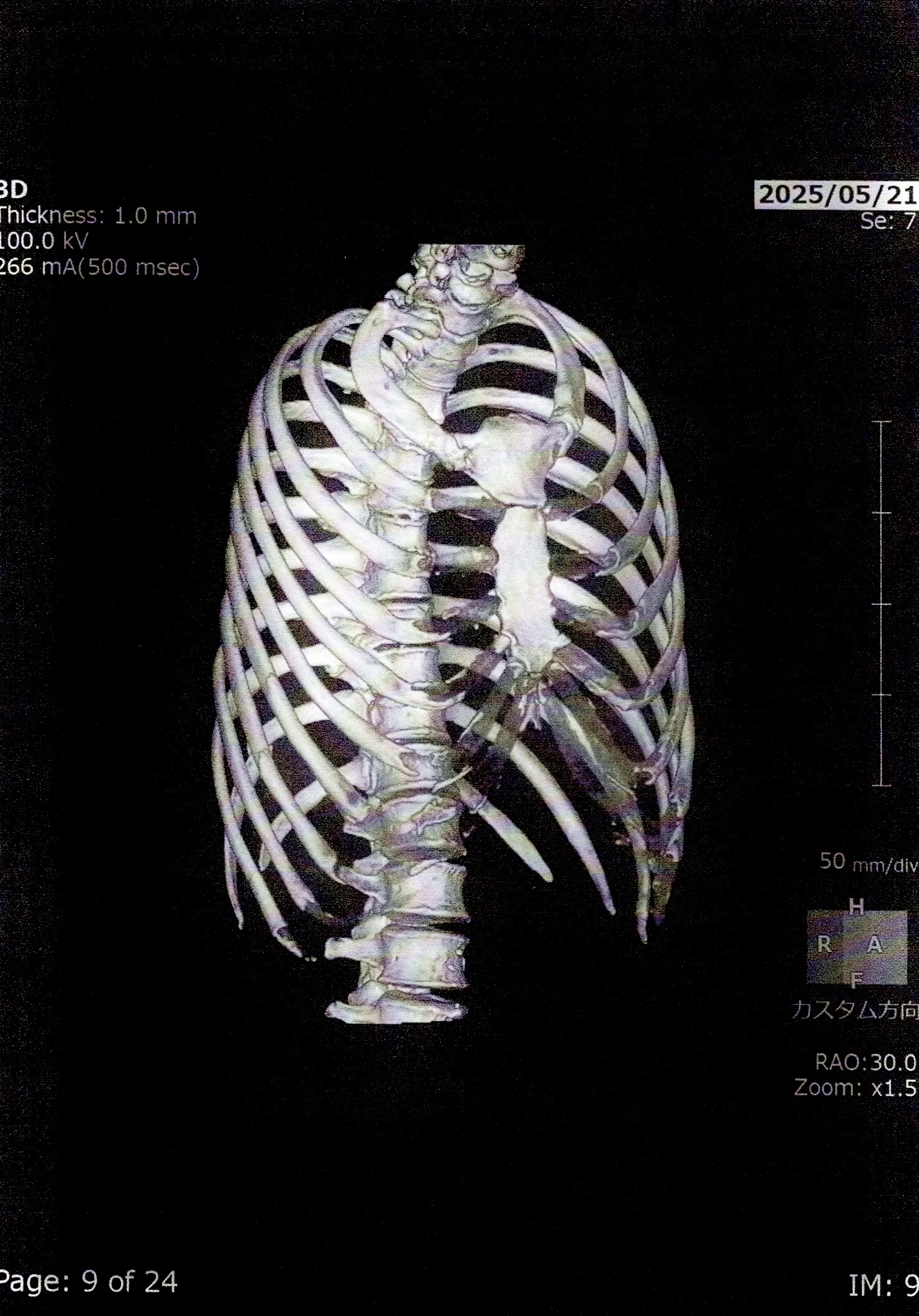 総合病院で撮影された肋骨のCT画像