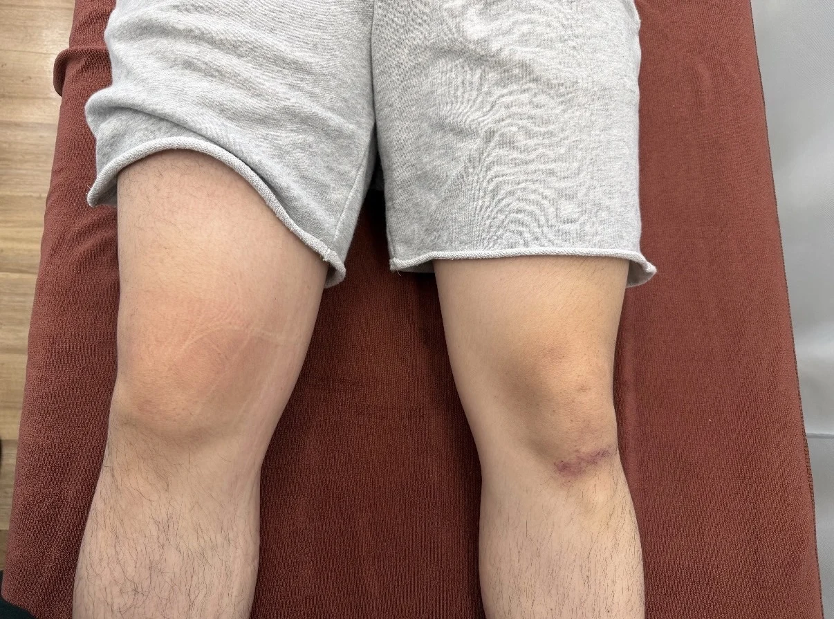 初回来院時の両膝の正面写真。右膝の腫れと左右差を確認