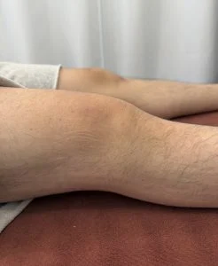 【症例】20代男性 右膝の強い痛み・腫れ｜前十字靱帯損傷と骨挫傷